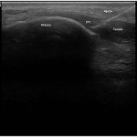 Electrolisis Percutanea Tendinopatia Rotuliana