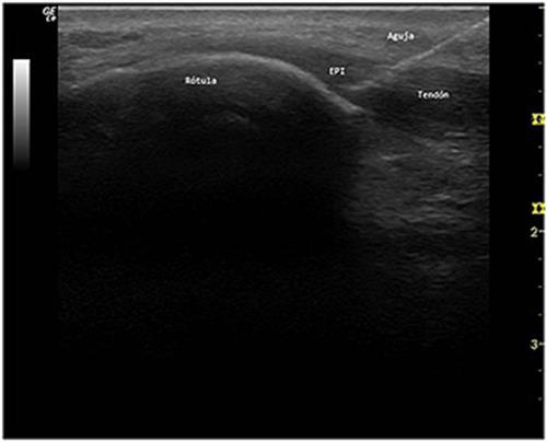 Lee más sobre el artículo Electrolisis Percutanea Tendinopatia Rotuliana