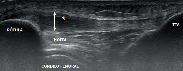 Ecografía de la rodilla que muestra la rótula, la grasa de Hoffa y el tendón rotuliano en la tendinopatía rotuliana